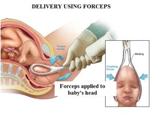 accouchement forceps rencontre parent enfant albi naissance respectée