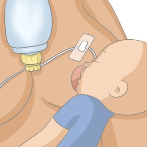 tétée DAL allaitement aide soutien lactation libres enfants du tarn prêt gratuit